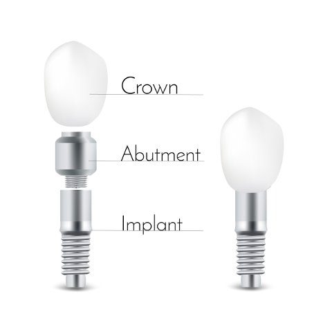 An implant is secured to your jaw like a normal tooth