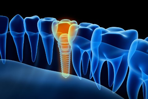 An implant is secured to your jaw like a normal tooth