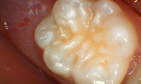 Dental fissure sealing