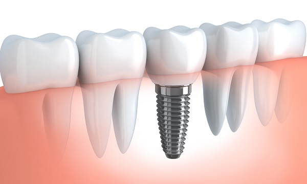 Dental Implants