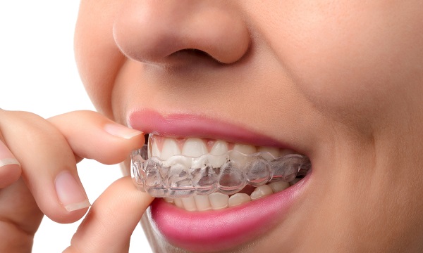 Invisalign