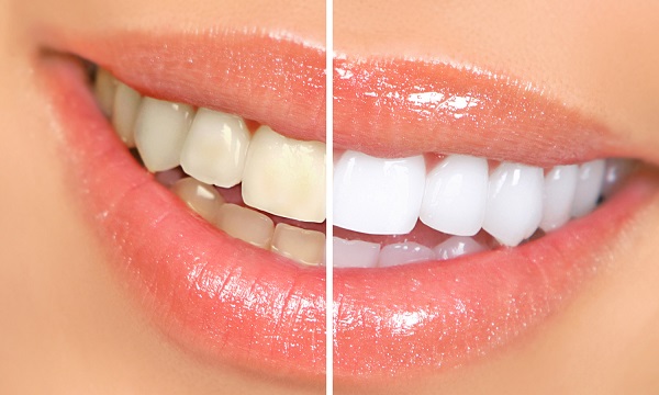 Difference between yellow and white teeth